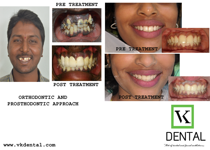SMILE CORRECTION/DESIGNING